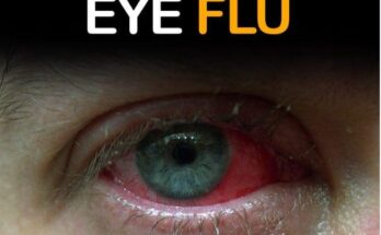 EYE FLU