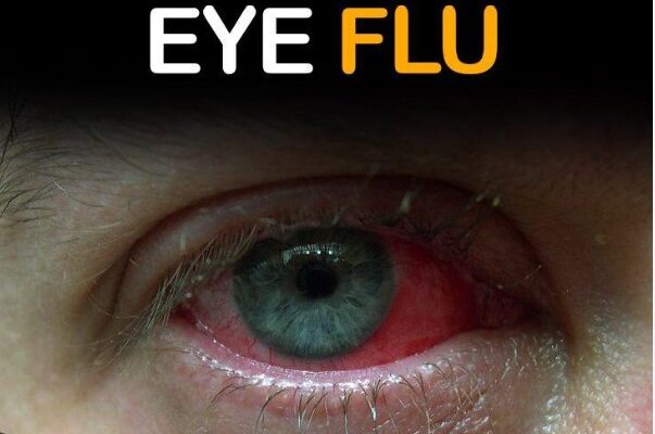 EYE FLU