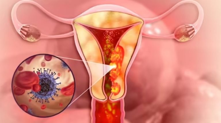 Health News: महिलाओं के लिए ‘साइलेंट किलर’ बना ये कैंसर, पहचान न होने पर बन जाते हैं जानलेवा