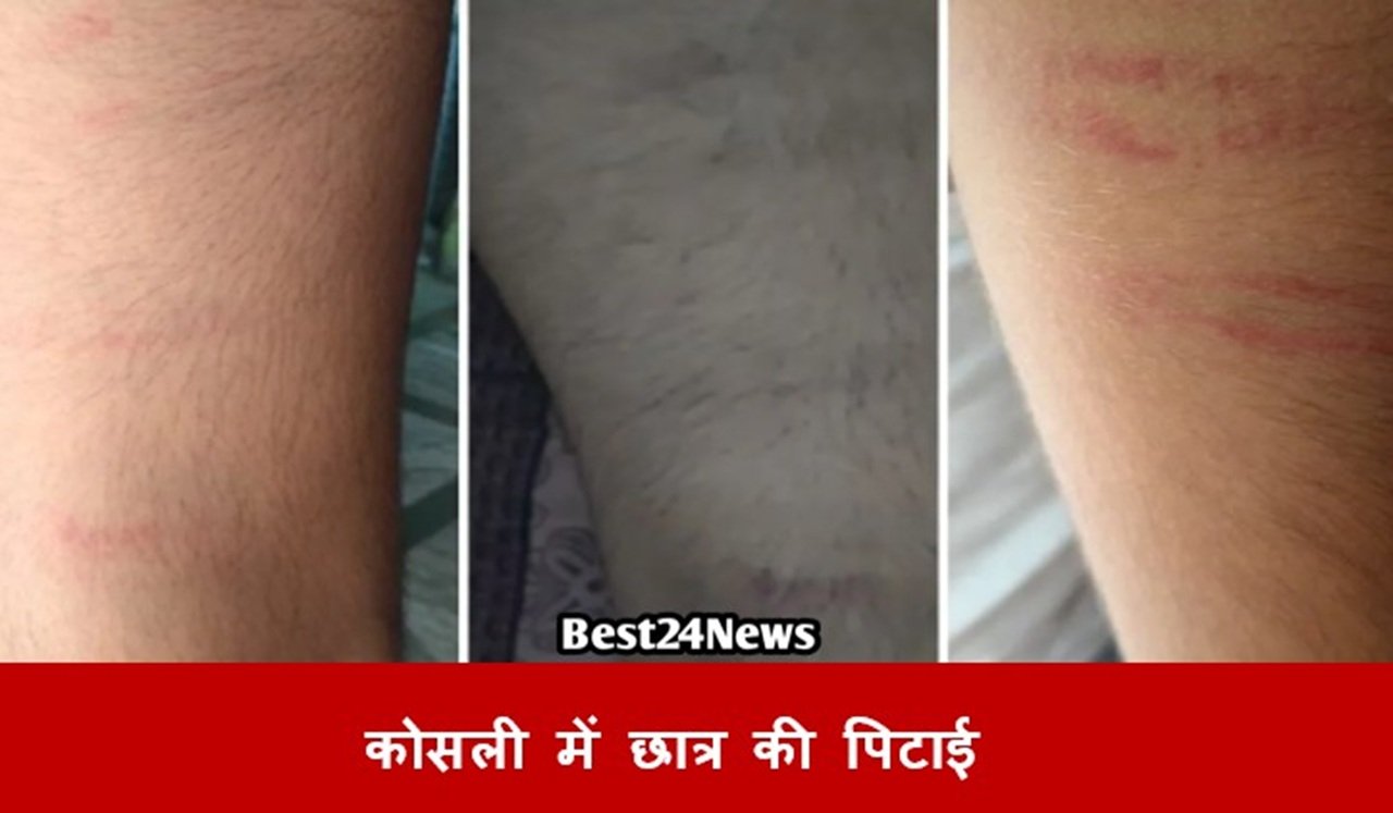 कोसली स्कूल में नौवीं कक्षा के छात्र की पिटाई से शरीर पर बने निशान